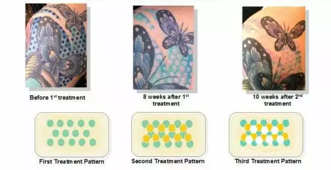 This image is a before treatments from Tatt2Away's non-laser tattoo removal service over the course of several weeks.